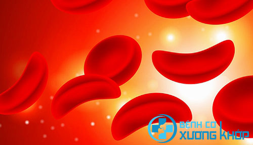 Hiểu bệnh thiếu máu hồng cầu hình liềm để phòng tránh tốt hơn