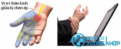 Hướng dẫn xoa bóp điều trị hội chứng ống cổ tay