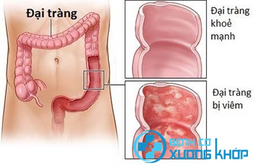 Lưu ý trong chữa bệnh viêm đại tràng Lưu ý trong chữa bệnh viêm đại tràng