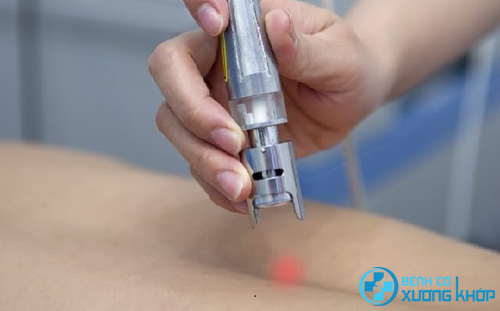 Điều trị bệnh thoát vị đĩa đệm bằng laser. Điều trị bệnh thoát vị đĩa đệm bằng laser.