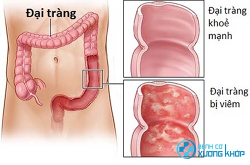 Mẹo chữa bệnh viêm đại tràng hiệu quả ngay tại nhà Mẹo chữa bệnh viêm đại tràng hiệu quả ngay tại nhà