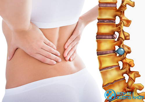 Thoát vị đĩa đệm cột sống thắt lưng gây ra những cơn đau nhức khó chịu. Thoát vị đĩa đệm cột sống thắt lưng gây ra những cơn đau nhức khó chịu.