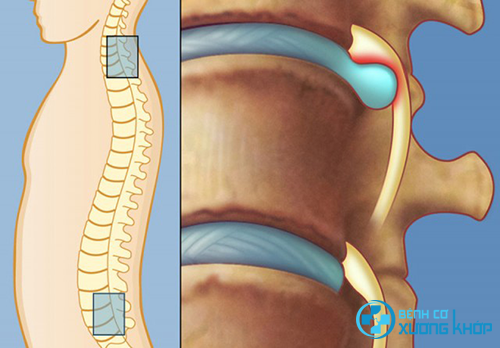 3 phương pháp áp dụng điều trị thoát vị đĩa đệm cột sống thắt lưng
