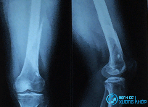 U tủy xương là hình ảnh khó bắt gặp khi chụp X – quang thoái hóa khớp gối