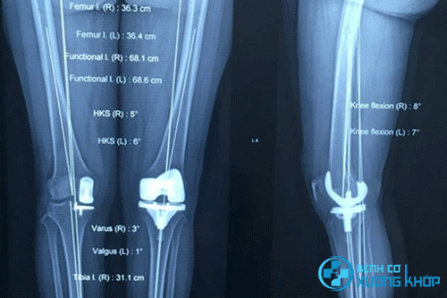 Hình ảnh X – quang bệnh nhân được thay khớp gối bán phần do sụn và xương dưới sụn đã bị hư hỏng hoàn toàn.