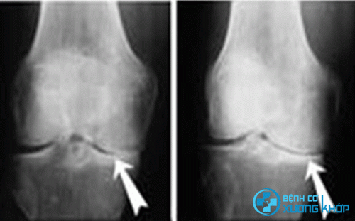 Hình ảnh X – quang thoái hóa khớp gối bị viêm do dịch khớp khô dẫn đến sự cọ xát giữa các đầu xương liên tục trong thời gian dài.