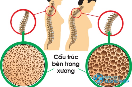 Thiếu canxi gây loãng xương dẫn tới tình trạng đau thắt lưng
