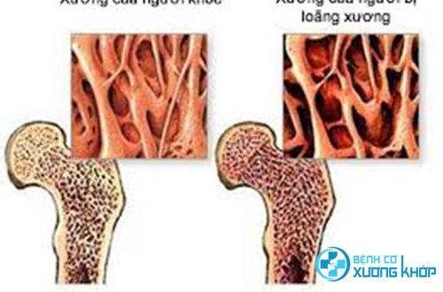 Chế độ dùng thuốc như thế nào tốt cho người bệnh loãng xương Chế độ dùng thuốc như thế nào tốt cho người bệnh loãng xương