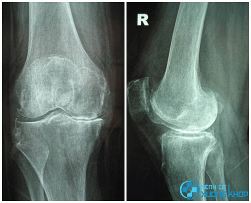 Hình ảnh X – quang thoái hóa khớp gối của một bệnh nhân.