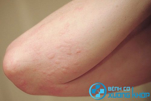 Một vài căn bệnh thường gặp ở da có nguy cơ lây nhiễm cao