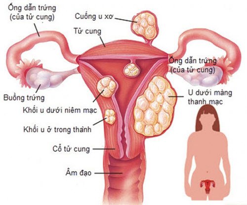 Những biểu hiện của u nang buồng trứng ở phụ nữ mang thai