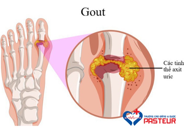 Bệnh Gout là gì?