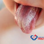 Bệnh nấm miệng là gì?
