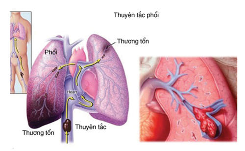 Phương pháp điều trị bệnh thuyên tắc mạch phổi