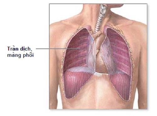 Phương pháp xử lý khí tràn màng phổi