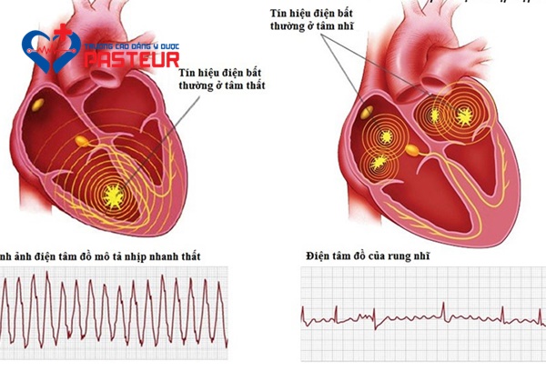 Dấu hiệu cảnh báo bệnh rối loạn nhịp tim