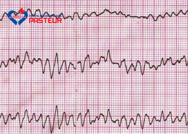 Các dấu hiệu cảnh báo rối loạn nhịp tim là gì?